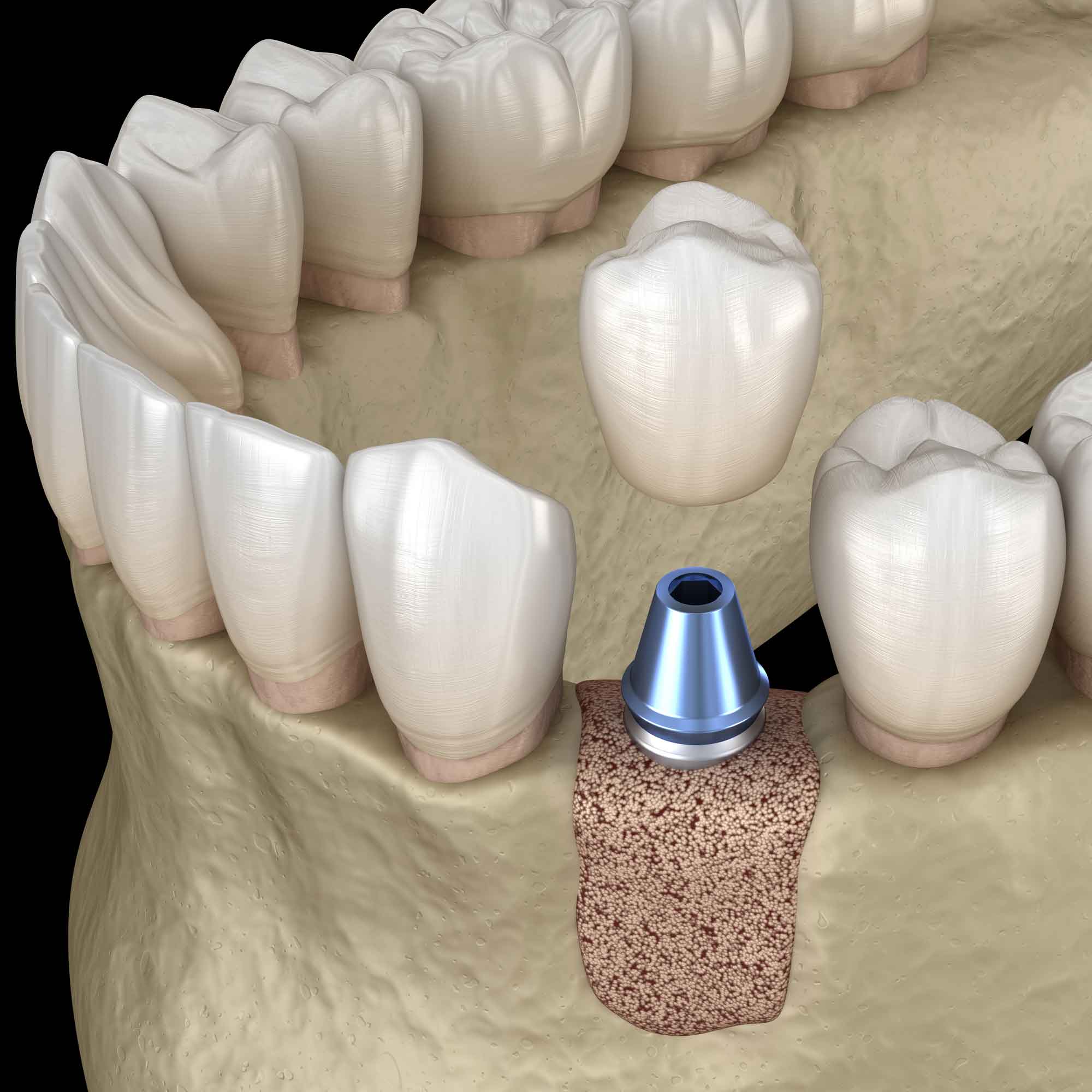 Значение аугментации в эстетической стоматологии