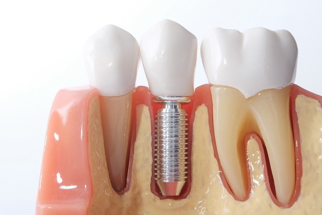 Имплантация в стоматологии Genesis