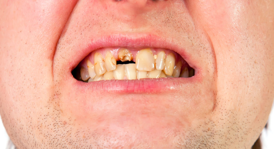 Пульпит зуба – симптомы, что это, лечение (хронический, острый)